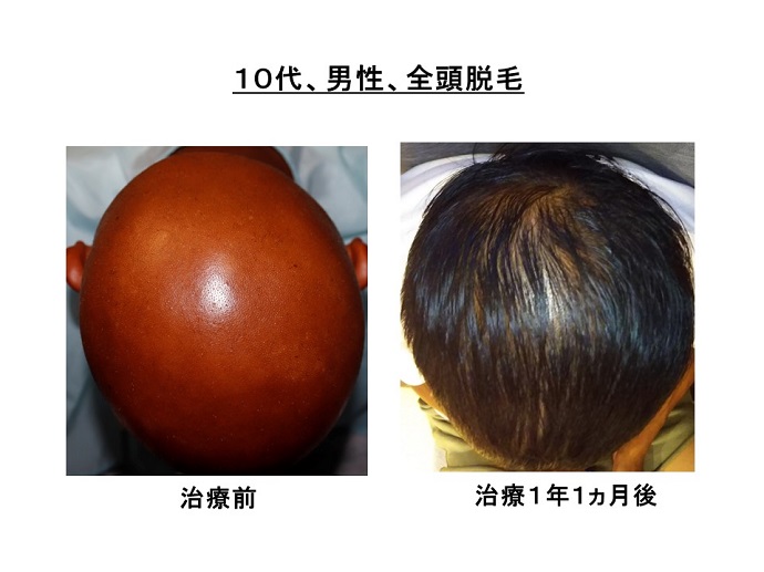 円形脱毛症　病院